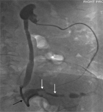 Nephrostogram performed a week after the procedure shows free flow of contrast ...