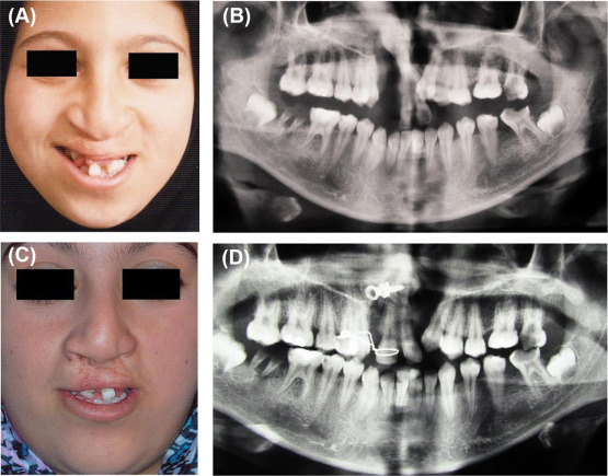 (A) Photograph taken during childhood shows protruded and twisted premaxilla. ...