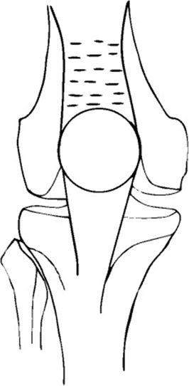 Schematic diagram of pie-crusting: the cuts begin at the patellar insertion of ...