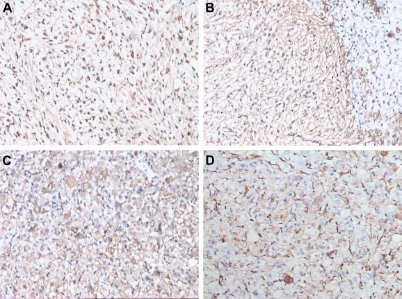 Immunopathological characteristics of hepatic perivascular epithelioid cell ...