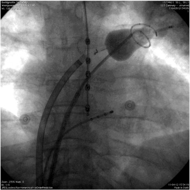 Fluoroscopic image of the setup of the endoscopic laser balloon system (PA ...