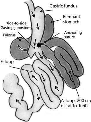 Illustration of single anastomosis gastric bypass surgery. The surgeon made a ...