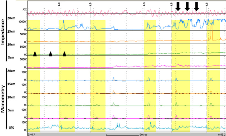 Impedance of a patient with achalasia shows low baseline impedance level ...