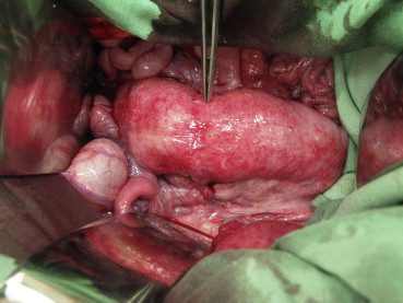 Healed anastomosis 5 days after it was glued with Glubran 2. The tweezers show ...