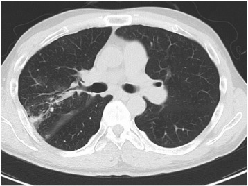 Both pulmonary artery right A2 and A3 were dilated by BPA. RPI was observed in ...