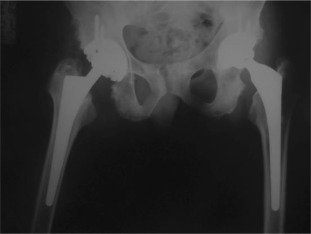 Four years after bilateral simultaneous THA.