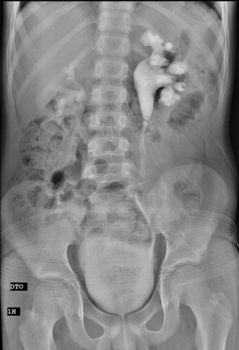 Urografia endovenosa mostra uma imagem de subtração transversal ao nível da JPU.