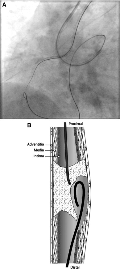A knuckle is formed on the retrograde wire by first fashioning a broad curve and ...