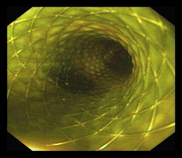 An 8 Fr 60-mm metallic wallstent in place of hepaticogastrostomy with bile flow.