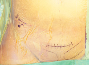 Incision. Pfannenstiel incision approximately 10 cm for modified Stoppa ...