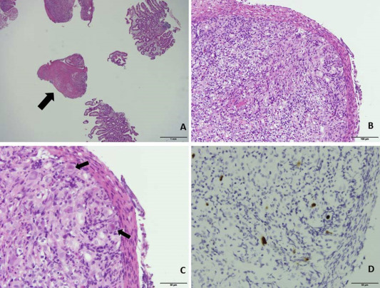 (A) Histopathology shows mucosa ulceration (arrows) under hematoxylin and eosin ...