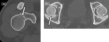 Casos donde falla el algoritmo de detección de contornos: a)articulación del ...