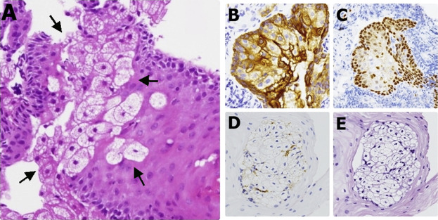 (A) Esophageal mucosa covered by benign squamous epithelium with focal ...