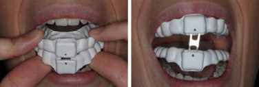 Vistas del dispositivo mandibular (DAM®) estudiado.