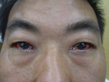 Bilateral conjunctivitis.