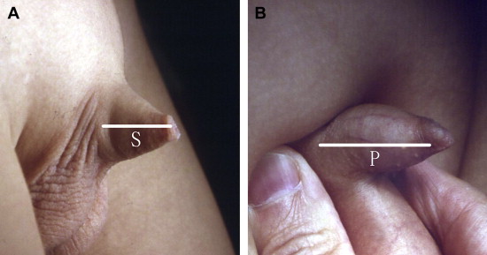 (A) Measuring the length of penile skin (S) with no or mild skin stretch; (B) ...