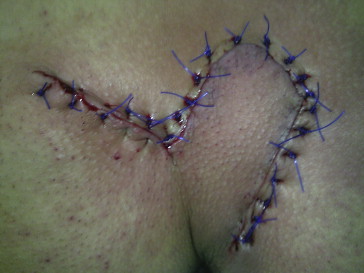 Flap is shown immediately after surgery.