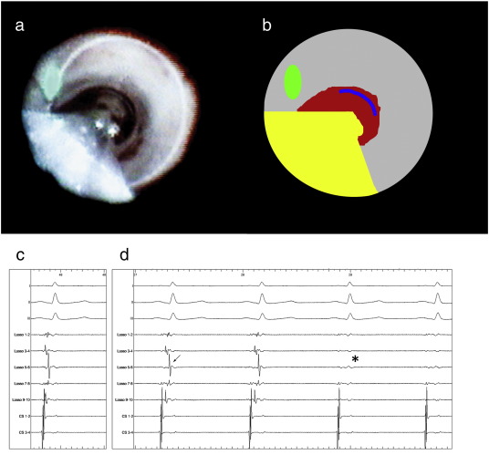 Panels a and b. Panel a displays the endoscopic view from the EAS in the left ...