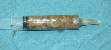 Appearance of the aspirated material.