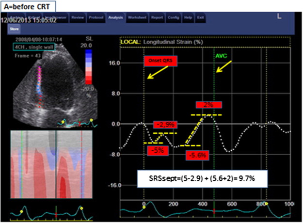 Title: Measurement of SRSsept.Legend: Example of septal rebound stretch ...