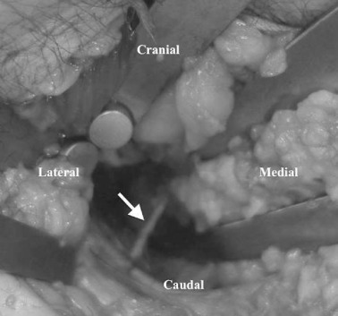 The obturator nerve. The obturator nerve (white arrow), which is prone to injury ...