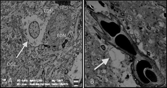(A) Increase in the apoptotic, degenerated glial cells (DGC) and electron dense ...