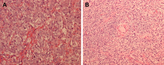 Histopathological examination of the adrenal specimen shows two different ...