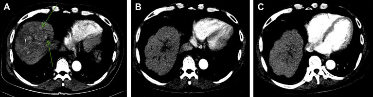 (A) Prior to thalidomide therapy, multiple arterially enhanced tumors were ...