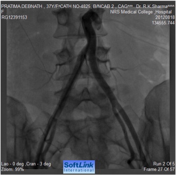 Abdominal aorta after the coarctation segment and iliac arteries.