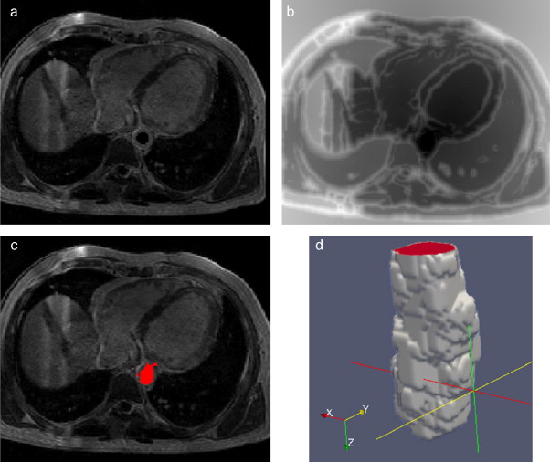 Segmentación de aorta descendente empleando Level Set. (a) Vista de un corte ...