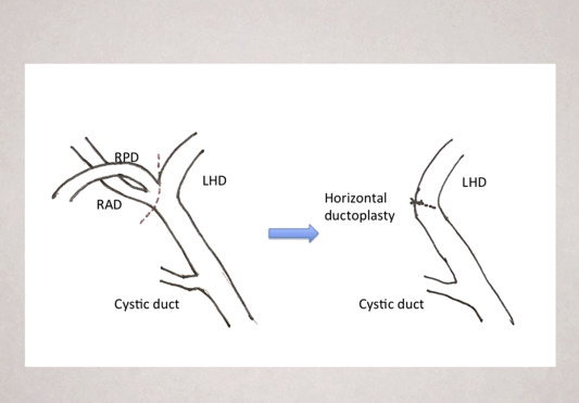 Schematic demonstration of bile duct cut plane and horizontal ductoplasty. ...