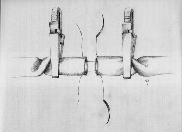 The conventional twisting technique.