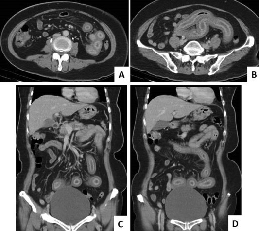 (A, B) Coronal view of contrast-enhanced computed tomography reveals segmental ...