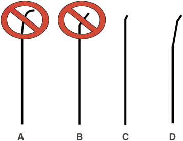 Secondary bend 3 to 6mm from the tip is useful if the proximal vessel is ...