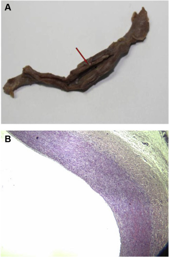 (A) Inferior vena cava specimen opened with black arrow depicting direction of ...