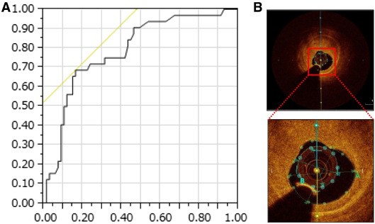 (A) Receiver operating characteristic curve analysis for MLA at target stenosis ...