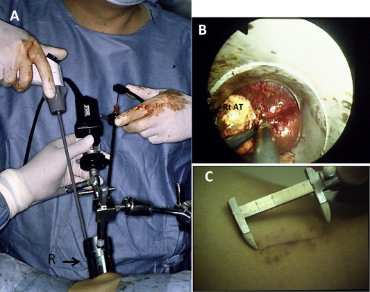 (A) Insertion of rectoscope tube into the retroperitoneal space; (B) ...