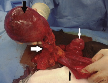 Appearance of the structures inside the right scrotum of the patient during the ...