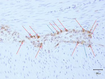 Bcl-2 immunostaining for immaturity of ganglia (2-day-old boy). Mature ganglion ...