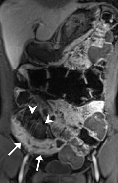 The same patient as in Figure 1. Coronal postcontrast VIBE image shows an active ...