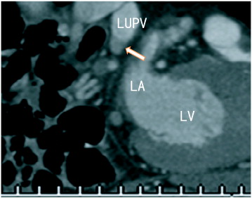 Sagittal images showed an occlusion of the lower branch of the left upper ...