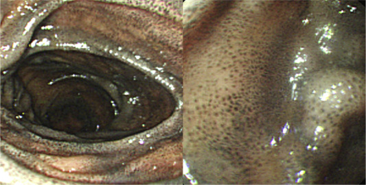Upper gastrointestinal endoscopy disclosed multiple discrete speckled black ...