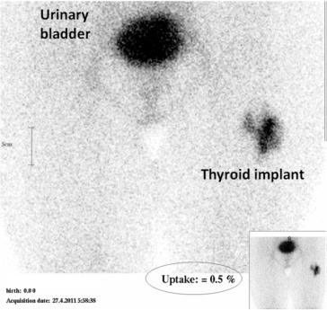 Normal isotope uptake (0.5%) by the implanted thyroid tissue in the left thigh.