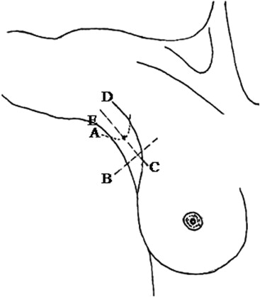 Schematic diagram showing the five landmarks on the skin of the axilla.