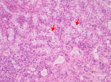 Estruturas tubuloglandulares revestidas por células cuboides de citoplasma claro ...