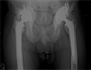 Bone-cement demarcation of left femur was present in the zones on Gruen ...