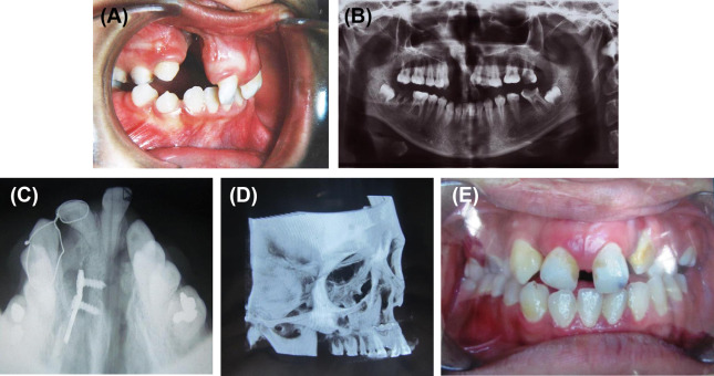 (A) Protruded premaxilla. (B) Orthopantomograph view showing rotated premaxilla. ...