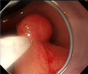 The elevation is immediately snared before it becomes flat and is removed using ...