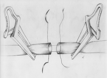 Placing two stitches to the middle of the posterior wall (6 o'clock position) ...