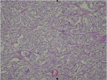 Tumor was composed of polygonal cells arranged in characteristic nested pattern ...